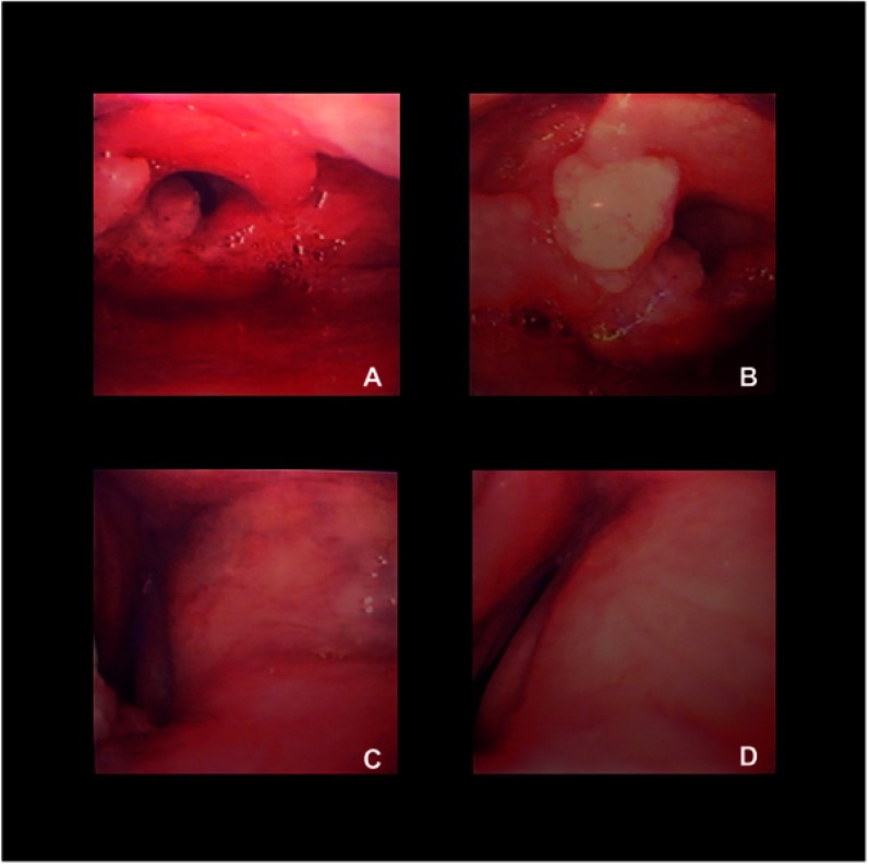 Awake tracheostomy in a patient with acute upper airway obstruction: an emergency application of an elective percutaneous procedure.