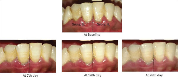 An evaluation of the efficacy of ethanolic extract of <i>Nigella sativa</i> L. (<i>Kalonji</i>) on the clinical parameters of moderate‑to‑severe gingivitis: A split‑mouth clinical study.