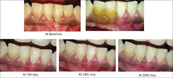 An evaluation of the efficacy of ethanolic extract of <i>Nigella sativa</i> L. (<i>Kalonji</i>) on the clinical parameters of moderate‑to‑severe gingivitis: A split‑mouth clinical study.