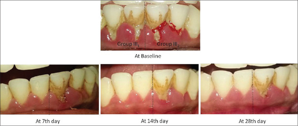 An evaluation of the efficacy of ethanolic extract of <i>Nigella sativa</i> L. (<i>Kalonji</i>) on the clinical parameters of moderate‑to‑severe gingivitis: A split‑mouth clinical study.