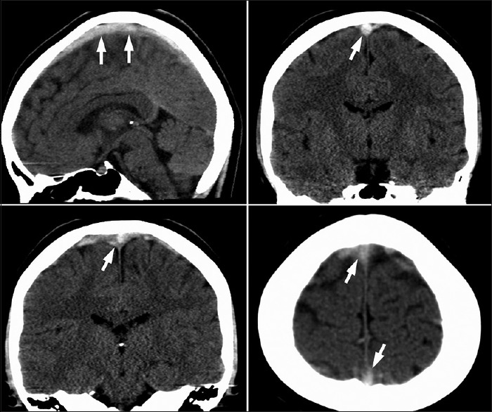 Seizure and left side weakness in a young female: Cerebral venous sinus thrombosis.