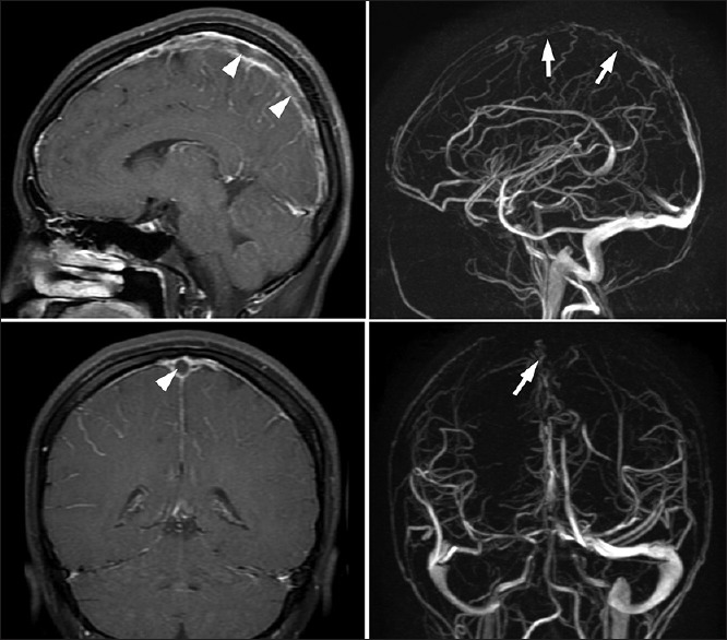 Seizure and left side weakness in a young female: Cerebral venous sinus thrombosis.