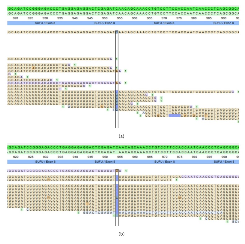 Novel <i>SUFU</i> Frameshift Variant Leading to Meningioma in Three Generations in a Family with Gorlin Syndrome.