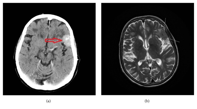 Novel <i>SUFU</i> Frameshift Variant Leading to Meningioma in Three Generations in a Family with Gorlin Syndrome.