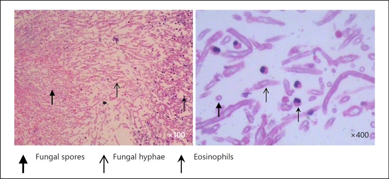 Asymptomatic Dialysate Turbidity and Repeated Intraductal Clots in a Peritoneal Dialysis Patient.