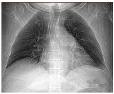 Use of Noninvasive Ventilation with Volume-Assured Pressure Support in Neuralgic Amyotrophy with Bilateral Diaphragmatic Paralysis.