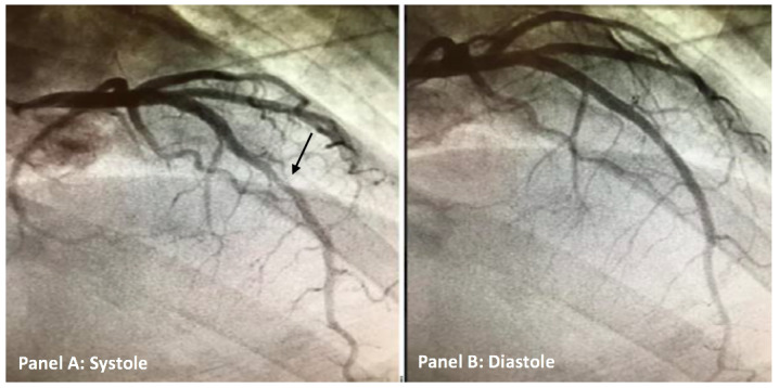 The Unusual Suspect: Gadobenate-Dimeglumine Induced Kounis Syndrome.