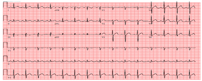 The Unusual Suspect: Gadobenate-Dimeglumine Induced Kounis Syndrome.