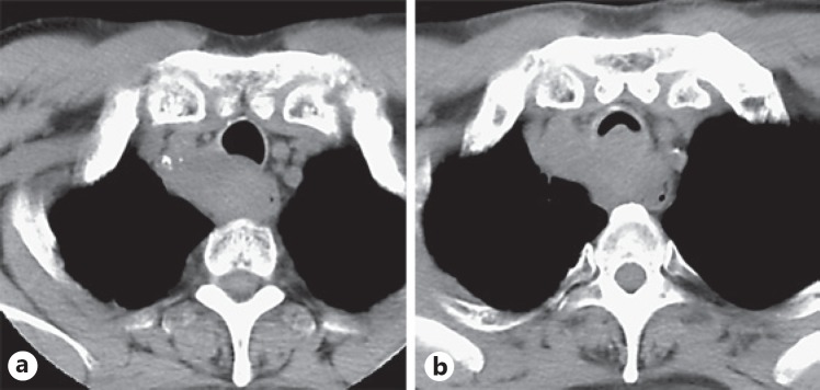 Rapid Progression of Tracheoesophageal Fistula Caused by Immunotherapy Administered after Tracheal Stent Placement.