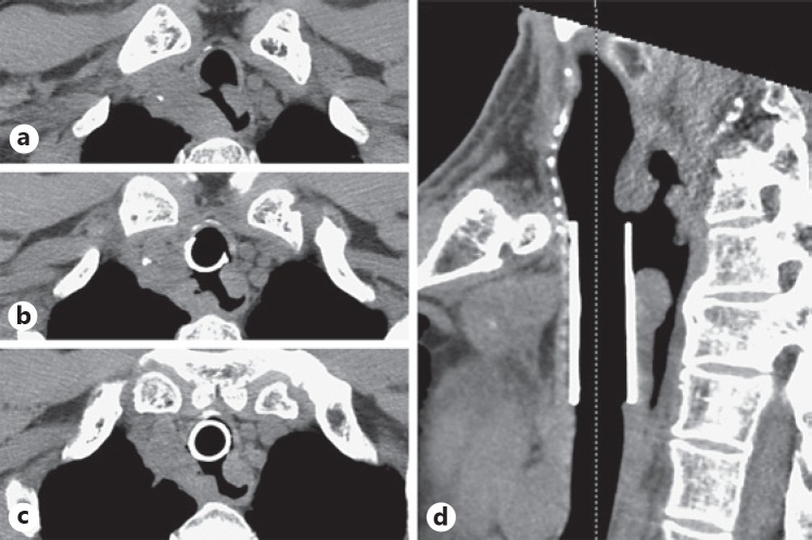 Rapid Progression of Tracheoesophageal Fistula Caused by Immunotherapy Administered after Tracheal Stent Placement.