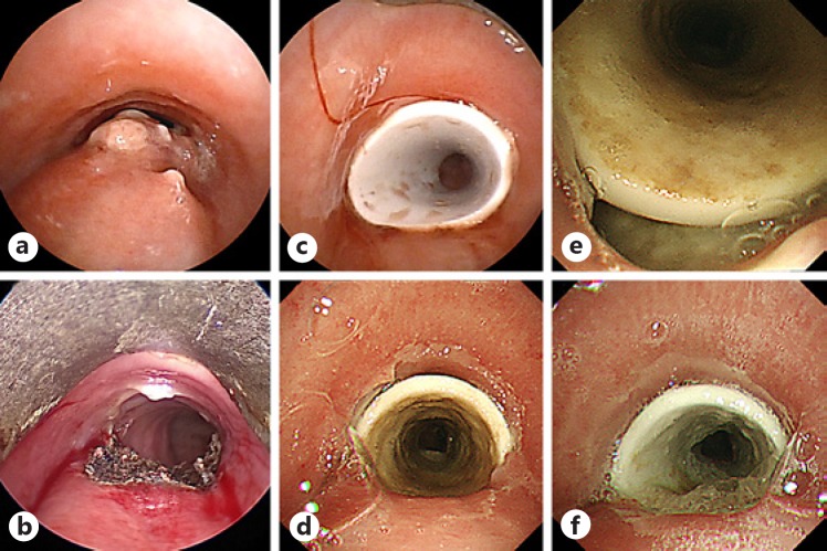 Rapid Progression of Tracheoesophageal Fistula Caused by Immunotherapy Administered after Tracheal Stent Placement.