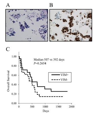 Serum CYFRA 21-1 but not Vimentin is Associated with Poor Prognosis in Advanced Lung Cancer Patients.