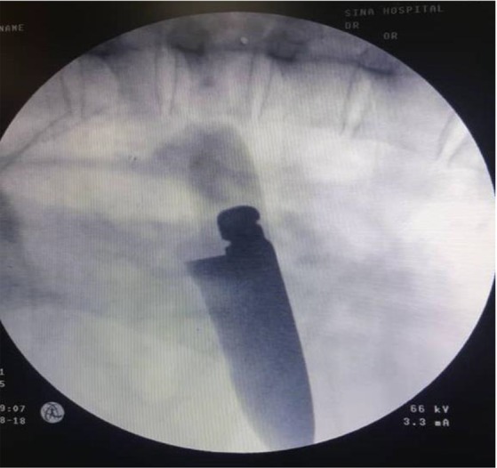 Management of a Penetrating Thoracic Injury with Thoracoscopy; A Case Study.