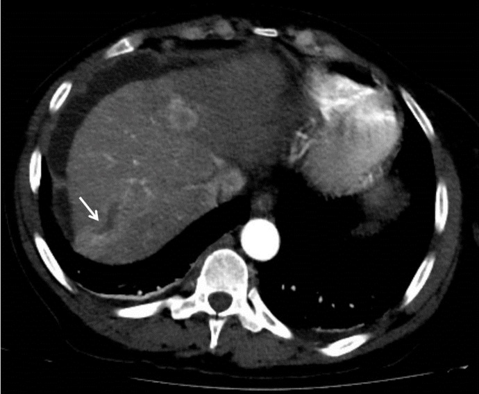 A Case of Humoral Hypercalcemia of Malignancy Secondary to Hepatocellular Carcinoma with Fulminant Clinical Course.