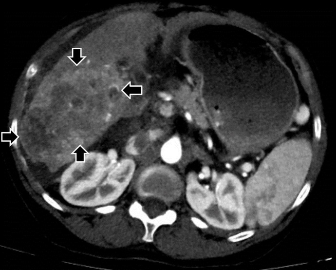 A Case of Humoral Hypercalcemia of Malignancy Secondary to Hepatocellular Carcinoma with Fulminant Clinical Course.