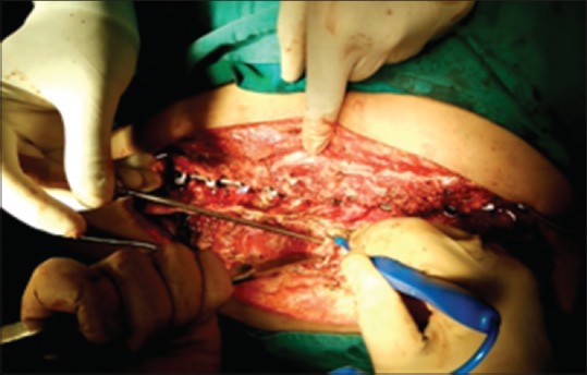 High-volume, Multilevel Local Anesthetics-Epinephrine Infiltration in Kyphoscoliosis Surgery: Blood Conservation.