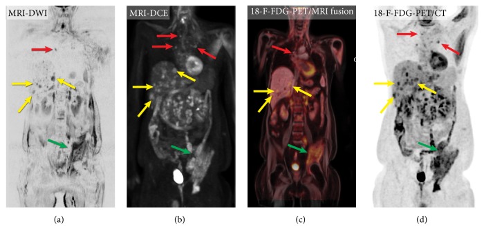 Medullary Thyroid Carcinoma: An Update on Imaging.