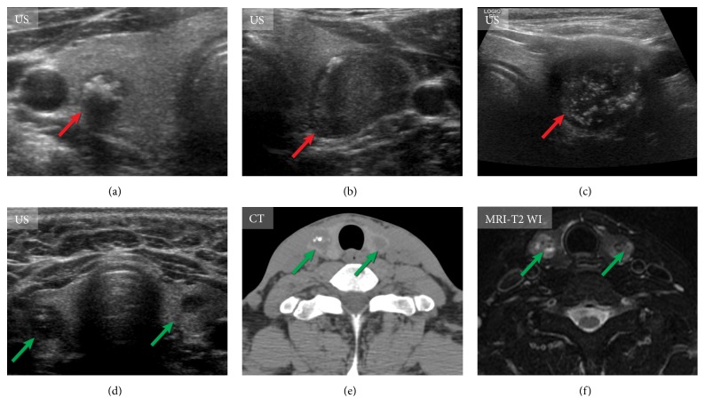 Medullary Thyroid Carcinoma: An Update on Imaging.