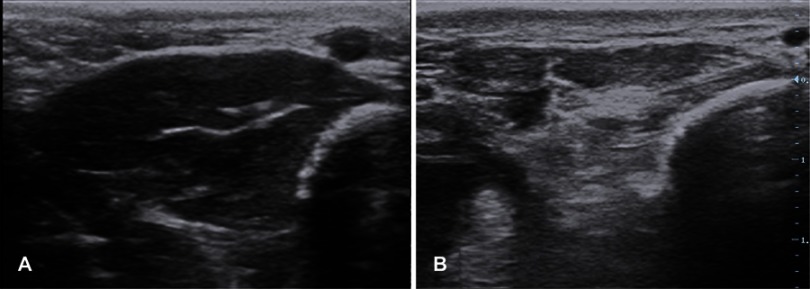 Clinical and research applications of neuromuscular ultrasound in amyotrophic lateral sclerosis.