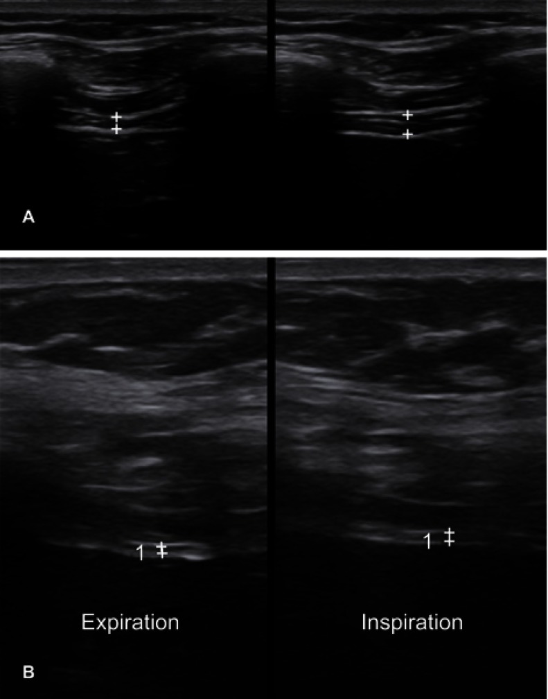 Clinical and research applications of neuromuscular ultrasound in amyotrophic lateral sclerosis.