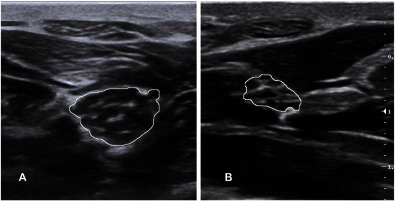 Clinical and research applications of neuromuscular ultrasound in amyotrophic lateral sclerosis.