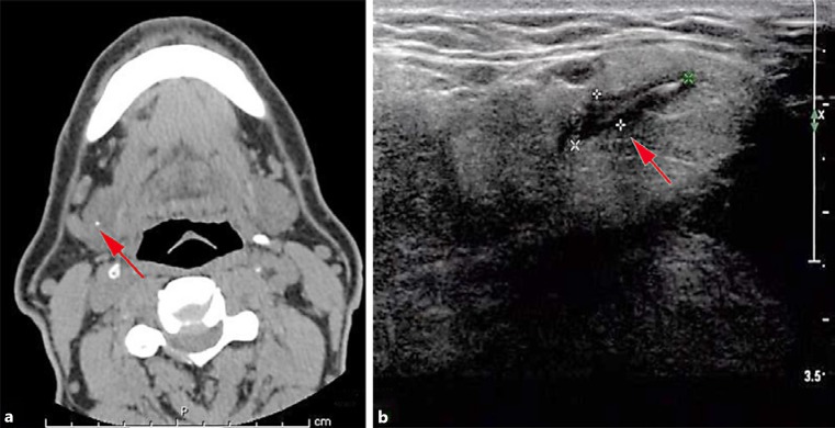 Migration of an Ingested Fish Bone to the Submandibular Gland: A Case Report and Literature Review.