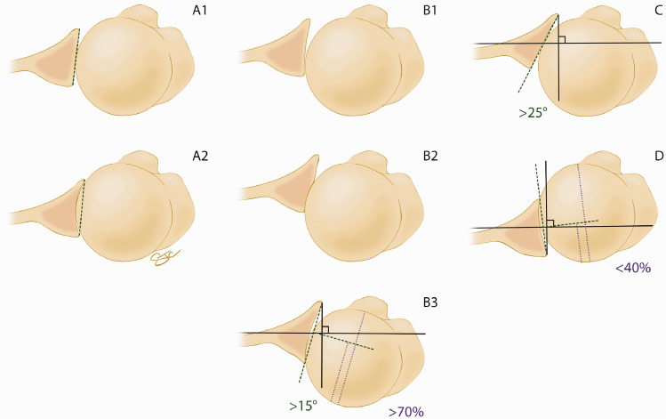 Eccentric Reaming for B2 Glenoids: History, Preoperative Planning, Surgical Technique, and Outcome.