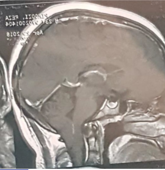 Spinocerebellar Atrophy Type-3 with Chiari Malformation in a Young Man: A Case Report.