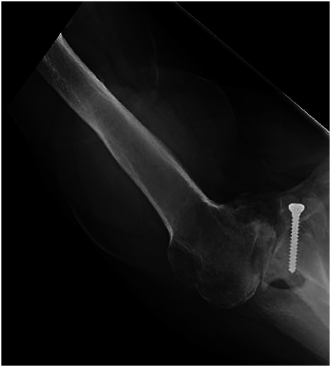 Eccentric Reaming for B2 Glenoids: History, Preoperative Planning, Surgical Technique, and Outcome.