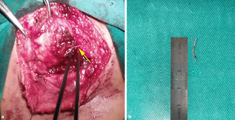 Migration of an Ingested Fish Bone to the Submandibular Gland: A Case Report and Literature Review.