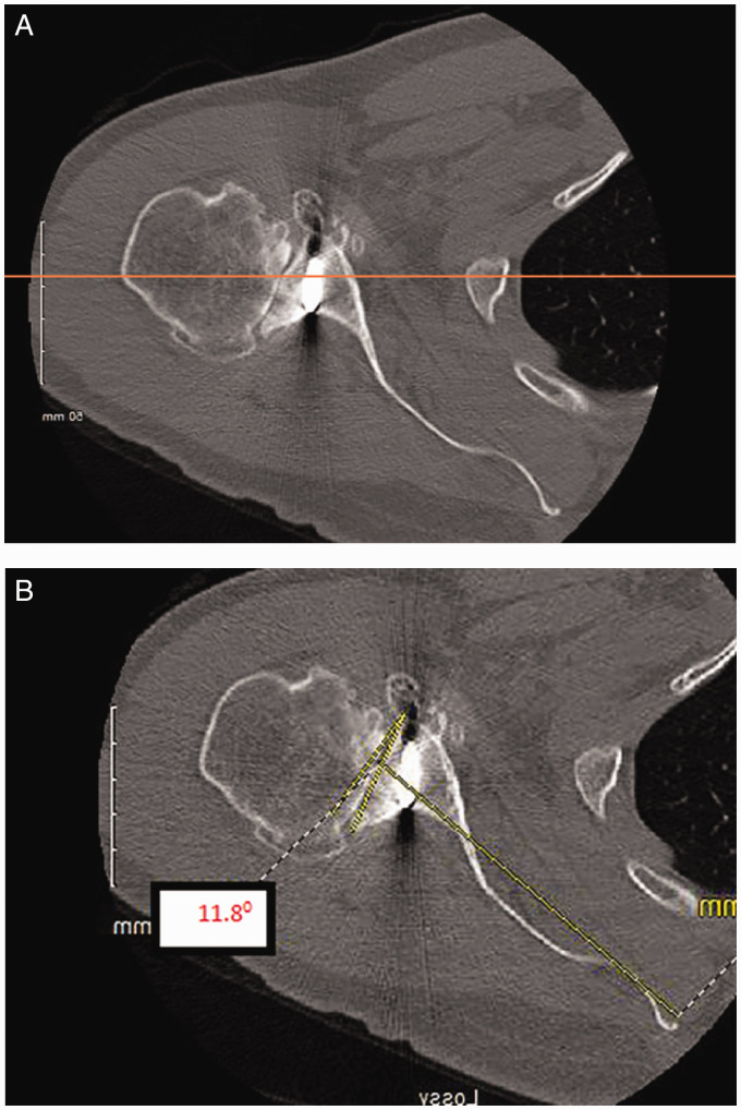 Eccentric Reaming for B2 Glenoids: History, Preoperative Planning, Surgical Technique, and Outcome.