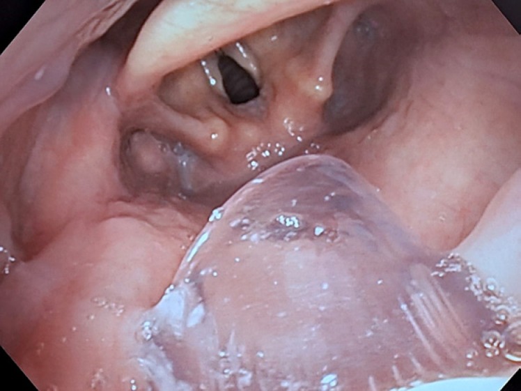 A Randomized Controlled Trial Comparing a Mapleson Circuit with Nasal Trumpet to Standard Oxygen Supplementation during EBUS Bronchoscopy under Monitored Anesthesia Care.