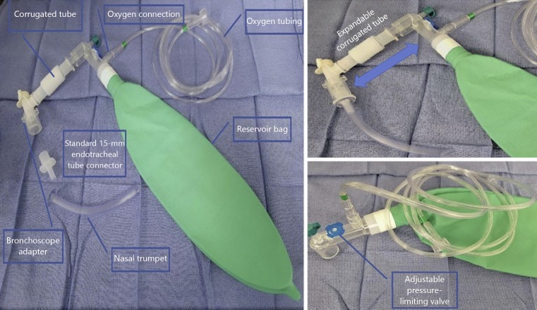 A Randomized Controlled Trial Comparing a Mapleson Circuit with Nasal Trumpet to Standard Oxygen Supplementation during EBUS Bronchoscopy under Monitored Anesthesia Care.