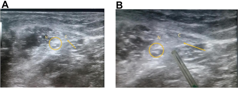 Long-term placement of continuous popliteal nerve block catheter for management of a wounded patient in a combat field environment: a case report.