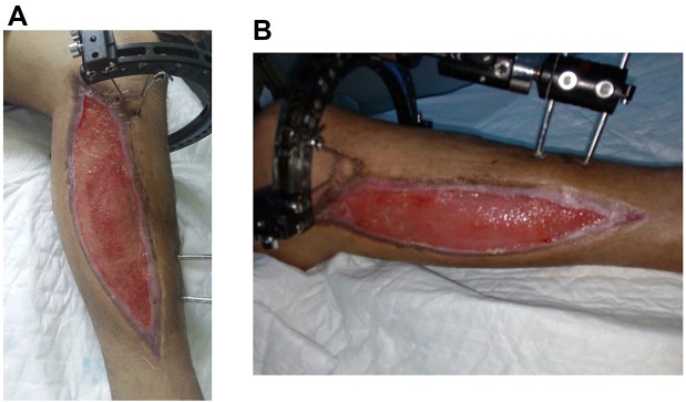 Long-term placement of continuous popliteal nerve block catheter for management of a wounded patient in a combat field environment: a case report.