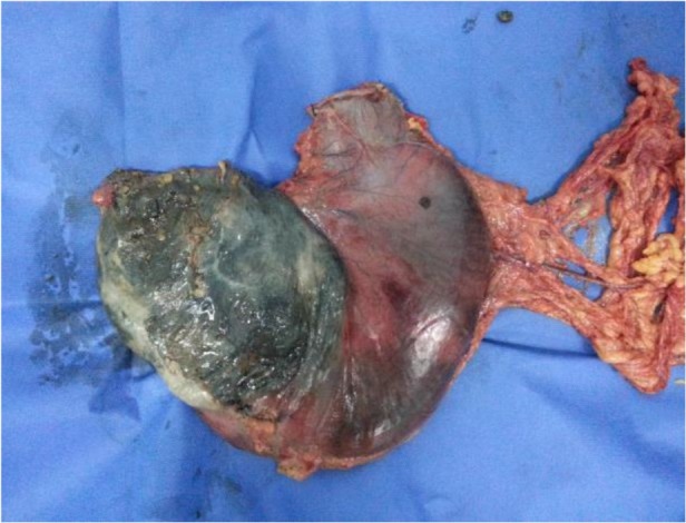 Acute Gastric Dilation Following Trauma: A Case Report.