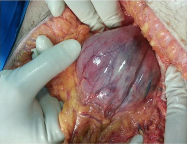 Acute Gastric Dilation Following Trauma: A Case Report.