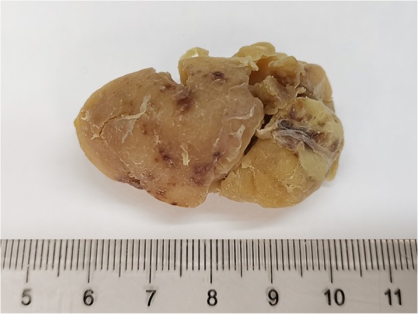 Primary hyaline vascular Castleman disease of the kidney: case report and literature review.