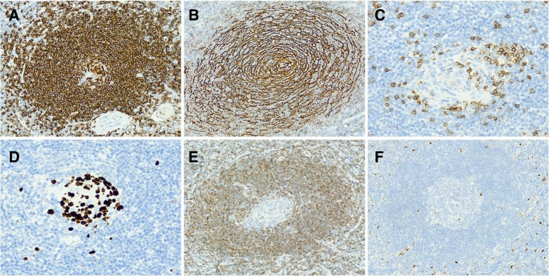 Primary hyaline vascular Castleman disease of the kidney: case report and literature review.