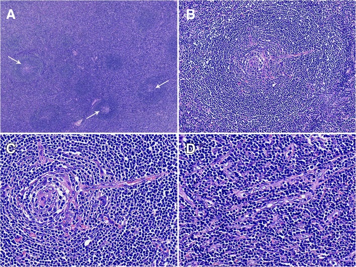 Primary hyaline vascular Castleman disease of the kidney: case report and literature review.