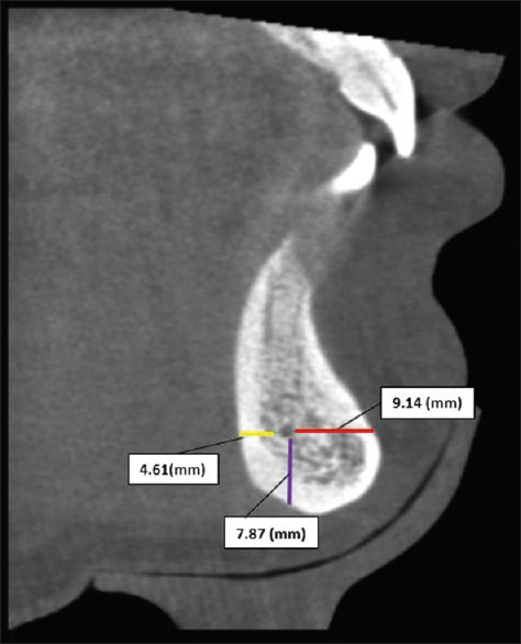 Assessment of prevalence and position of mandibular incisive canal: A cone beam computed tomography study.