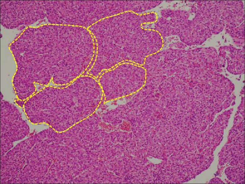 A primary paraganglioma of the liver mimicking hepatocellular carcinoma.