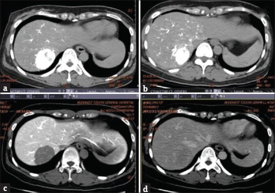 A primary paraganglioma of the liver mimicking hepatocellular carcinoma.