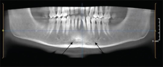 Assessment of prevalence and position of mandibular incisive canal: A cone beam computed tomography study.