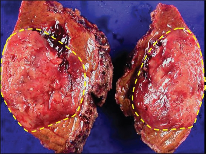 A primary paraganglioma of the liver mimicking hepatocellular carcinoma.