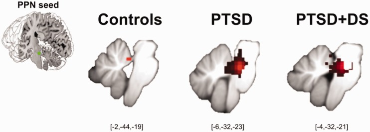 Back to the Basics: Resting State Functional Connectivity of the Reticular Activation System in PTSD and its Dissociative Subtype.