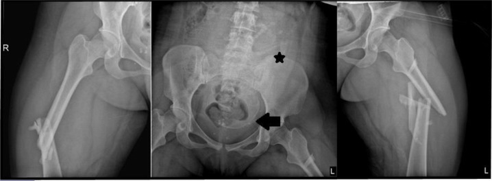 A 21-year-old Pregnant Trauma Patient with Asymptomatic Fat Embolism; a Case Report.