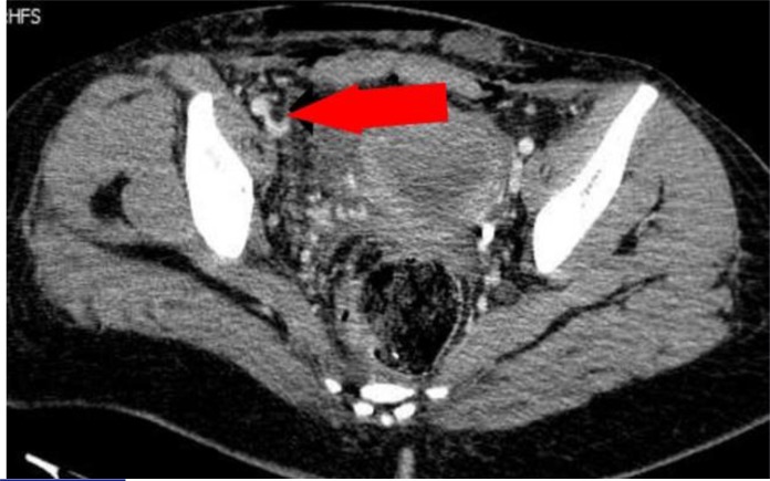 A 21-year-old Pregnant Trauma Patient with Asymptomatic Fat Embolism; a Case Report.