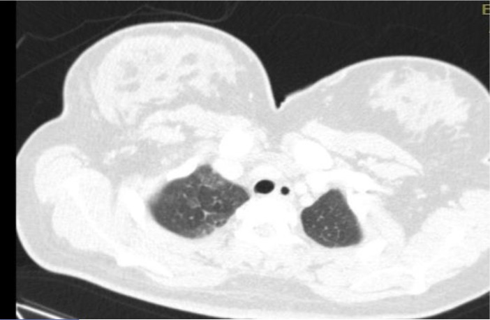 A 21-year-old Pregnant Trauma Patient with Asymptomatic Fat Embolism; a Case Report.