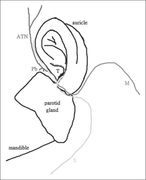 Intra-auricular modification of facelift incision decreased the risk of Frey syndrome.